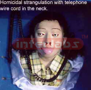 Homicidal strangulation with telephone wire cord in the neck